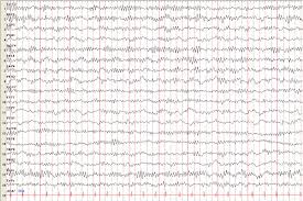 EEG