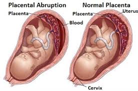 abruption