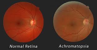 achromatopsia