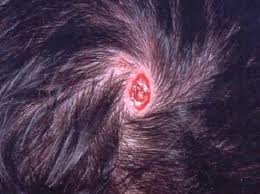 aplasia