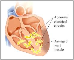 arrhythmia