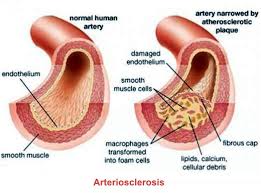 arteriosclerosis