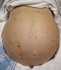 ascites