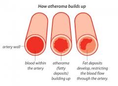 atheroma