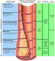 atherosclerosis