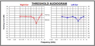 audiometry