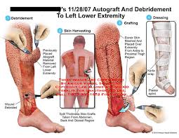 autograft