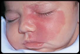 birthmark