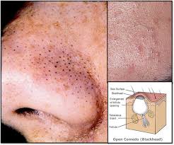 blackhead