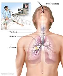 bronchoscopy