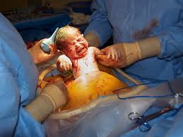 caesarian