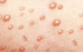 chickenpox
