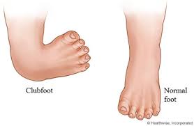 club-foot