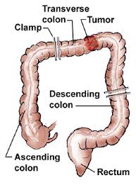 colectomy