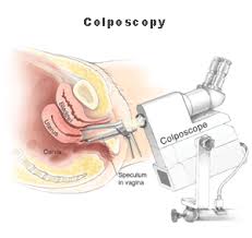 colposcopy