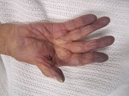 cyanosis