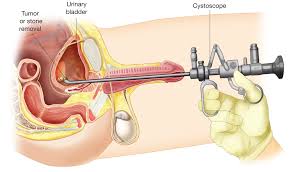 cystoscopy