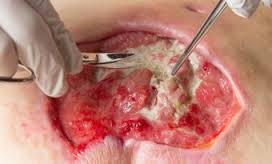 debridement
