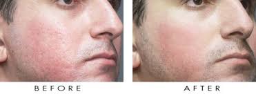 dermabrasion