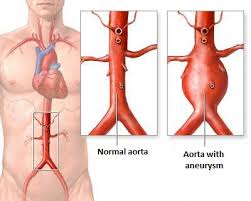 dilatation