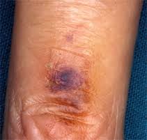 discoloration