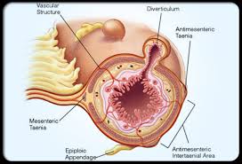 diverticulum
