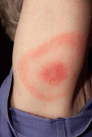 erythema