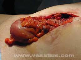 evisceration