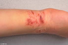 excoriation