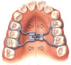 expander