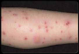 flea-bite