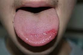 glossalgia
