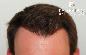 hairline