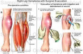 hematoma