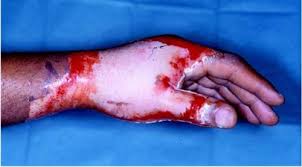 heterograft