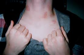 hickie