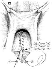 hymeneal