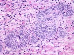 hyperplasia