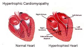 hypertrophy