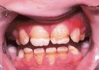 hypoplasia