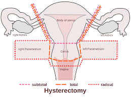 hysterectomy