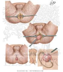 imperforate