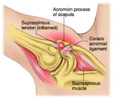 impingement