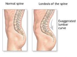 lordosis