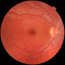 macular