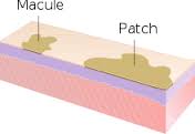 macule