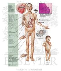 malabsorption