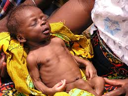 malnourishment