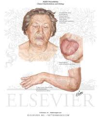 myxedema