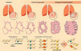 neoplasia